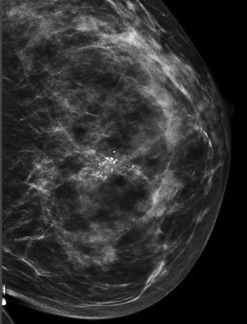 Breast Calcifications: What Are They, and What Follow-Up is Necessary?