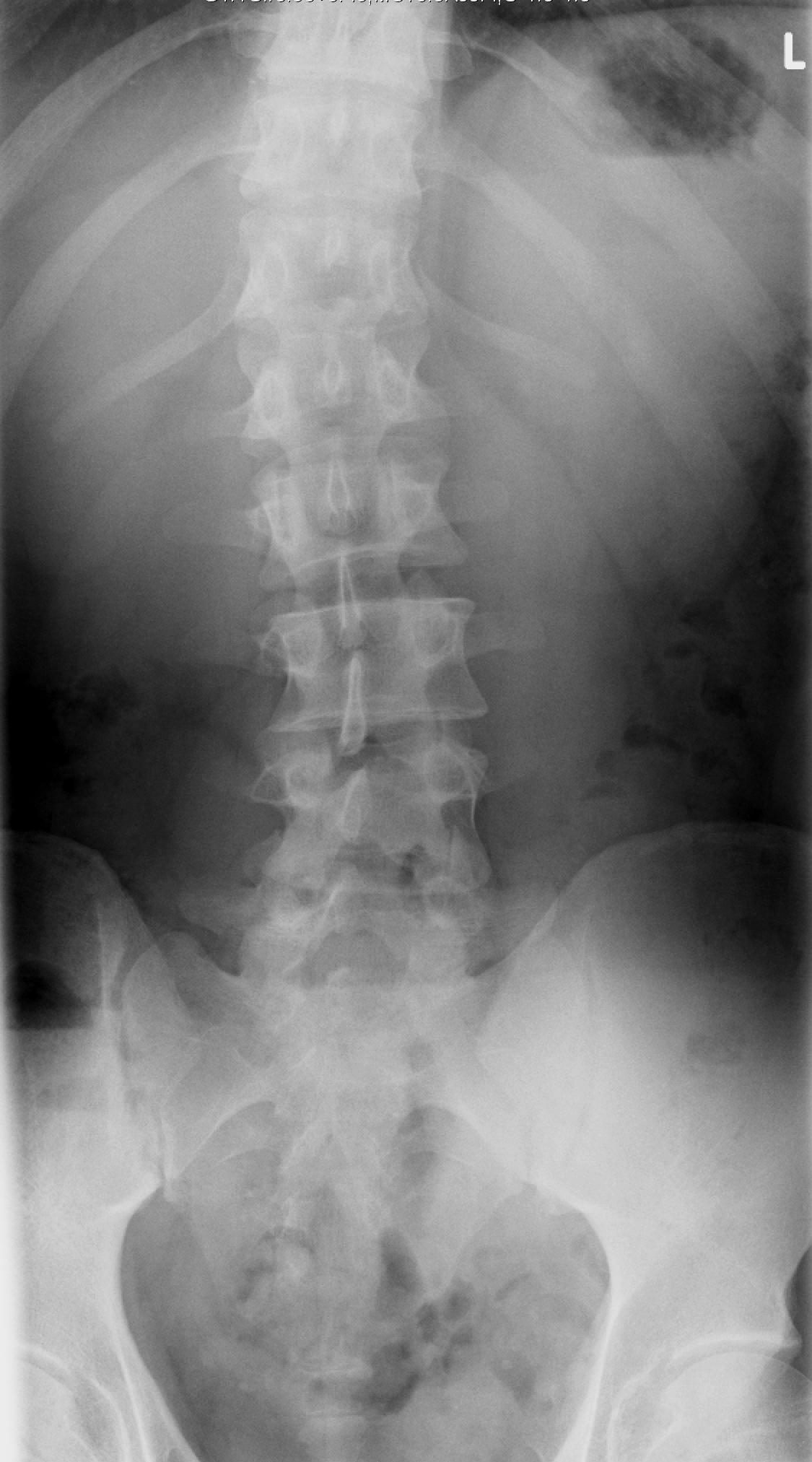 Mom Has a Spine Fracture: What are Her Options?