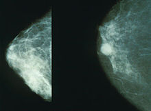 Should I get a 3-D or Traditional Mammogram?
