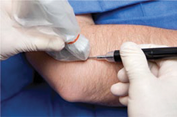 Tenex Health TX™: Revolutionary Treatment for Chronic Tendonitis
