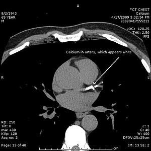 CT cardiac calcium 