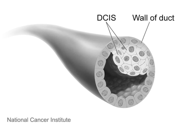 DCIS-1