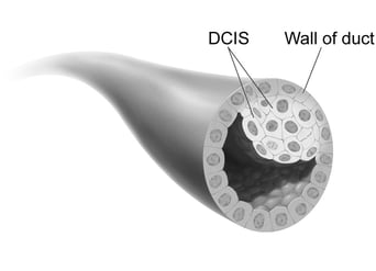 DCIS_closeup