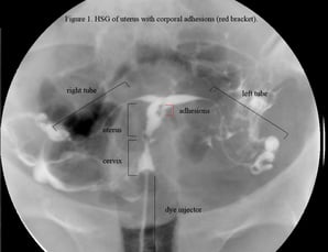 HSG_Ashermans_syndrome