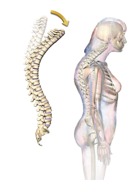 spinal-compression-fractures-causes-and-treatments