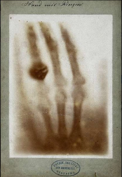 Roentgen X-ray