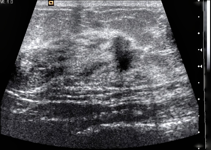 breast ultrasound