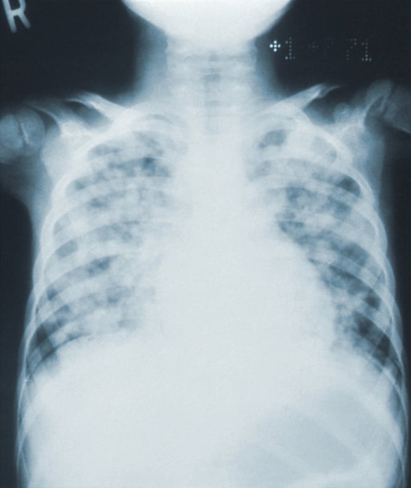 chest-x-ray-unsplash