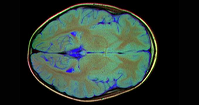 Brain-MRI