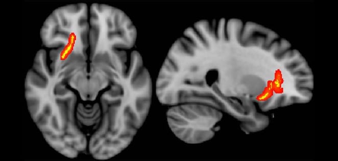 Brain-MRI-by-Radiological-Society-of-North-America
