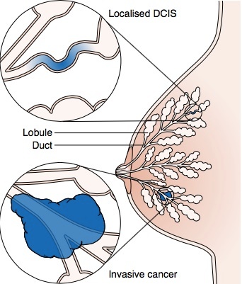 What Is DCIS, and How Is It Treated?