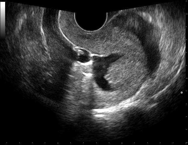 What Is a Sonohysterogram?