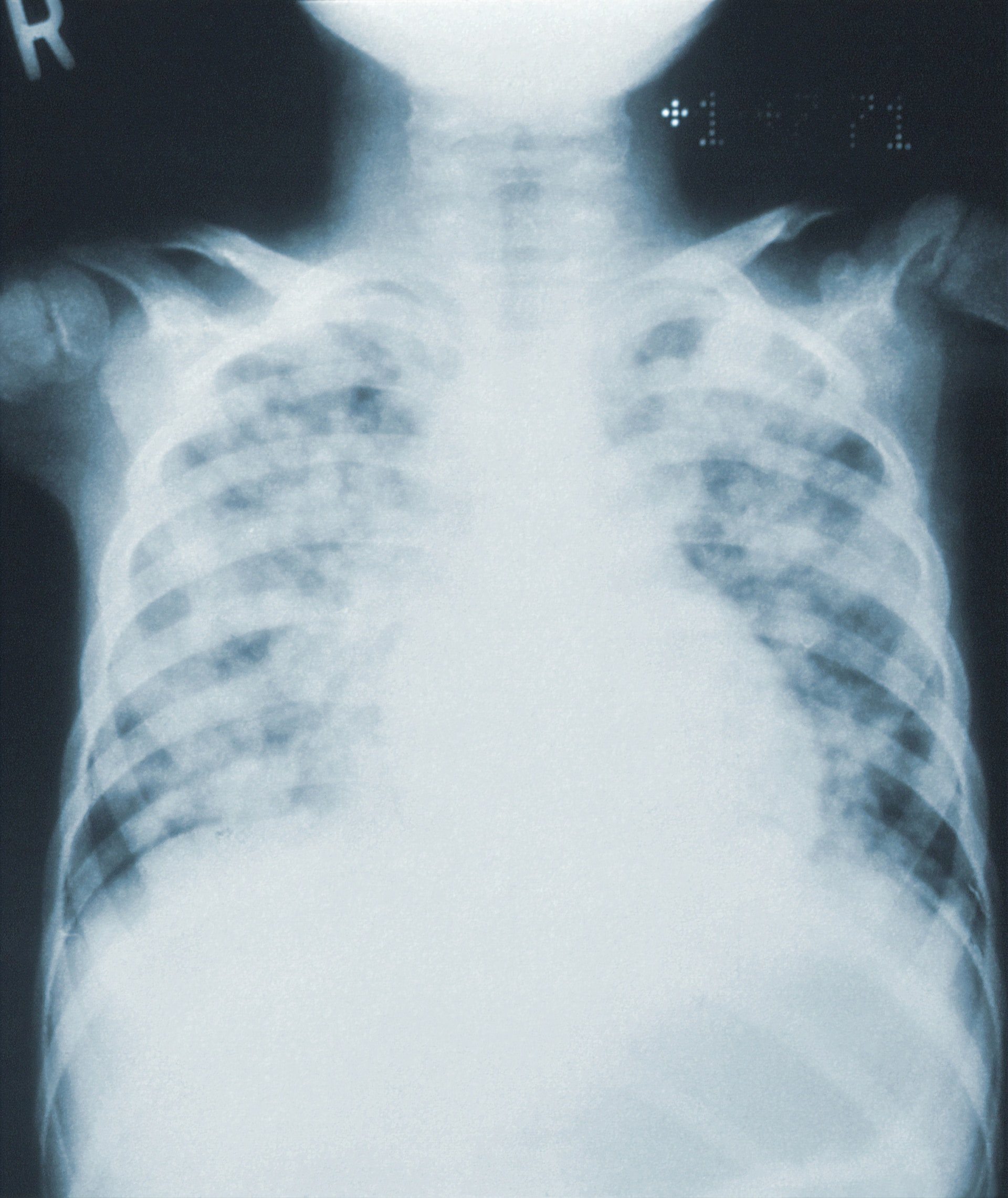 The Role of X-rays in Cancer Screening & Early Detection
